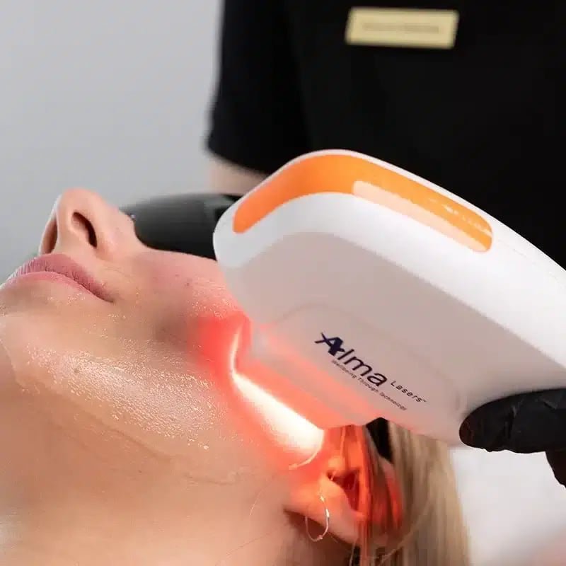 NIR Near-Infrared skin tightening treatment face Broxbourne Hertfordshire